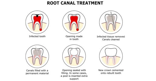 Root Canal Treatment dentist in Chester-le-Street