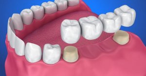 dental bridge