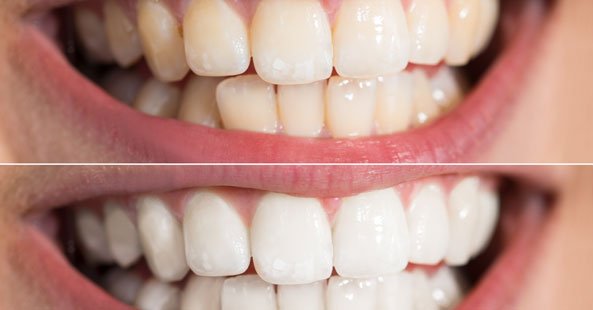 Image of teeth whitening by Vitality Dentist in Northallerton, North Yorkshire