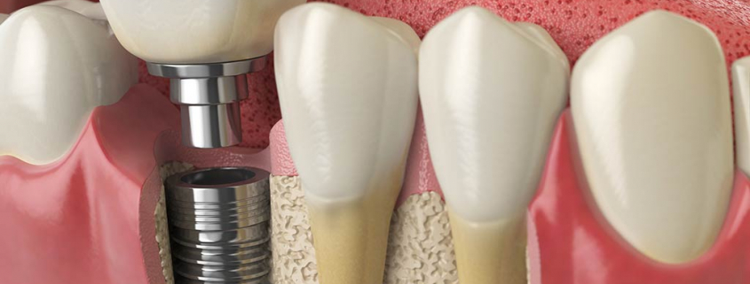 Dental Implants at Vitality Dental in Northallerton, Yorkshire