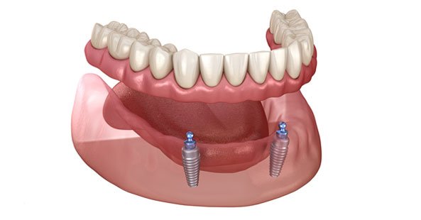 Dental Implants in Northallerton - Visit Vitality Dental Care, a local dentist in Northallerton, North Yorkshire