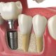 Dental Implants at Vitality Dental in Northallerton, Yorkshire