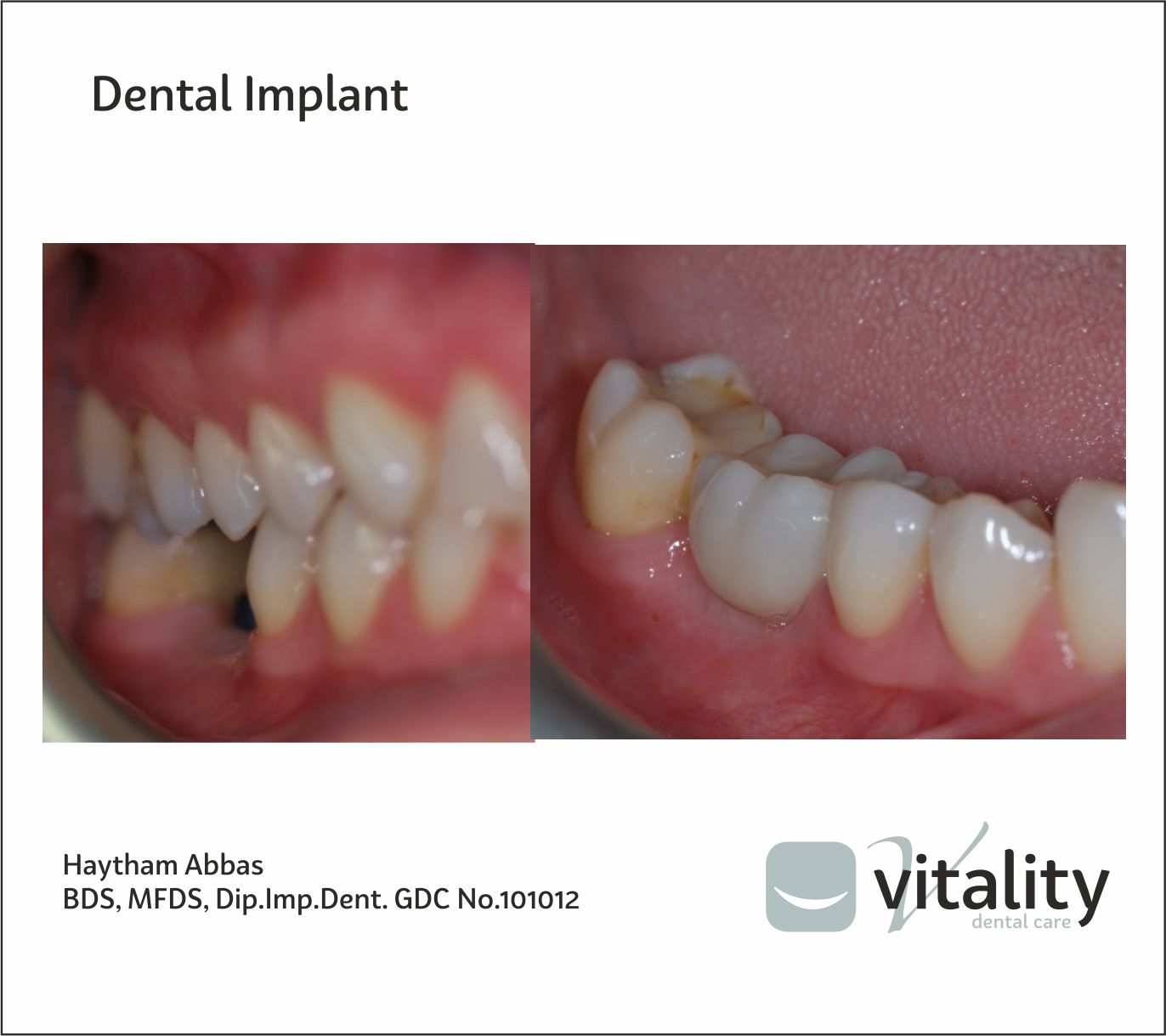 Dental implant HA LR6 Vitality Dental Care Stokesley