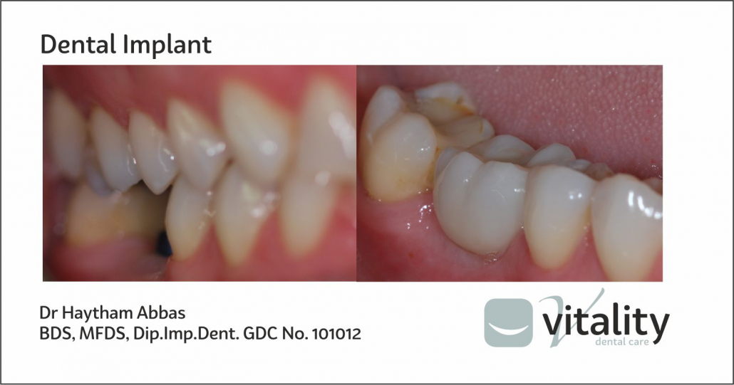Dental Implants from Vitality Dentist in Northallerton, North Yorkshire