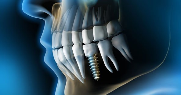 Xray image of a dental implant by Vitality Dental Care, a local Dentist in Northallerton, North Yorkshire