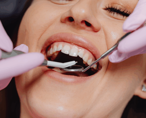 Dentist fixing a chipped tooth