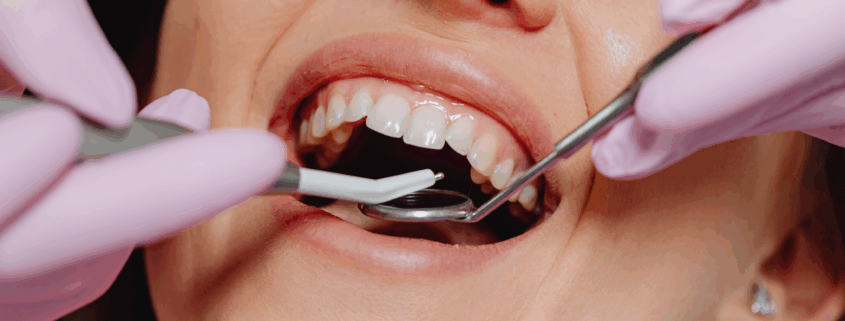 Dentist fixing a chipped tooth